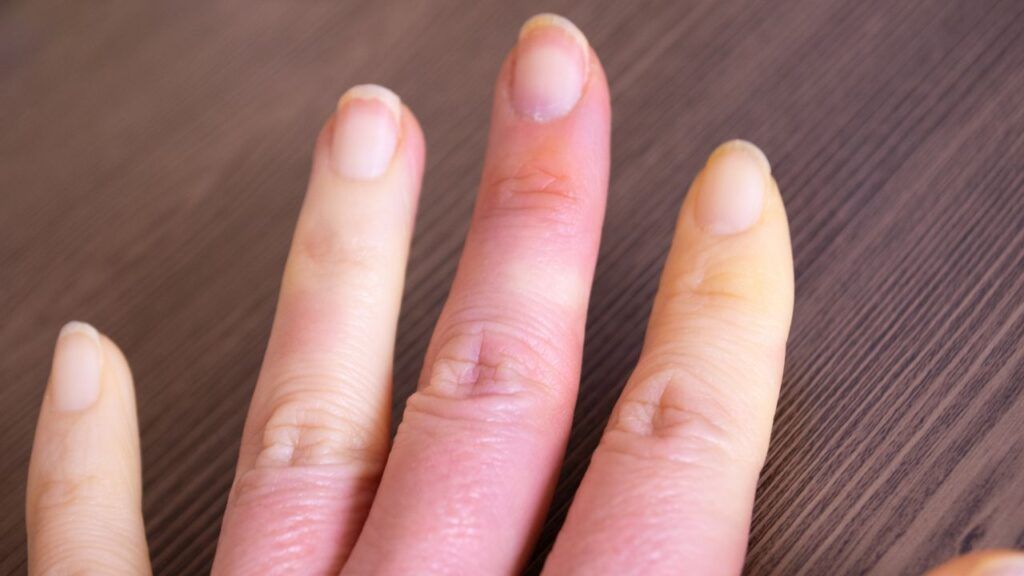 Esclerodermia.